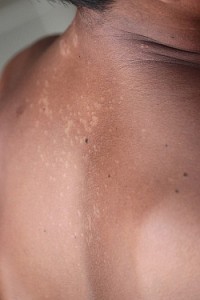 Tinea versicolor skin
