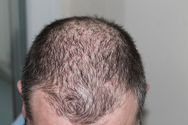 Man hair loss